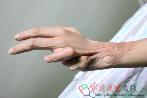 手被烫成鬼爪样 手指畸形如何修复？